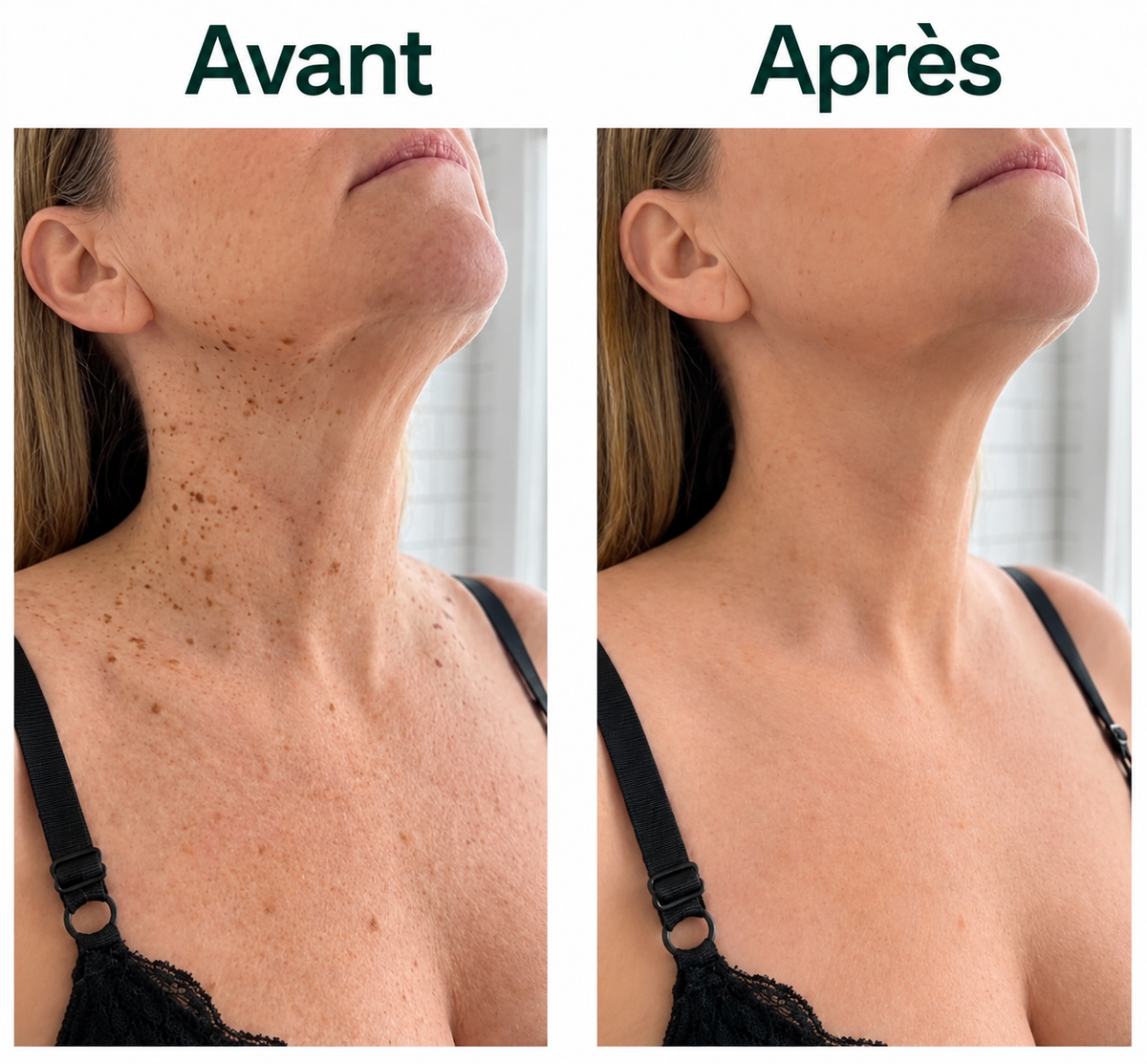 Kéralia™ – Stick exfoliant à l’acide glycolique pour les kératoses séborrhéiques
