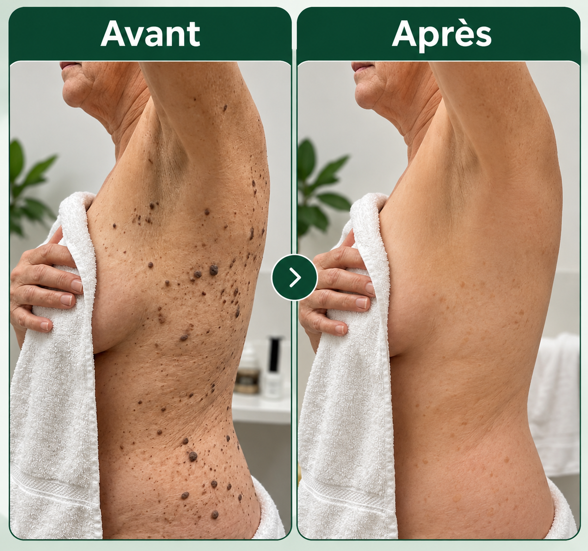 Kéralia™ – Stick exfoliant à l’acide glycolique pour les kératoses séborrhéiques