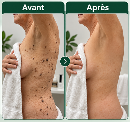 Kéralia™ – Stick exfoliant à l’acide glycolique pour les kératoses séborrhéiques